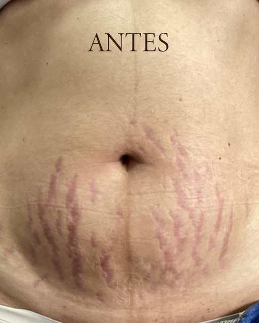 Antes del tratamiento de estrías: Abdomen