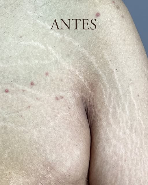 Antes del tratamiento de estrías: Pecho