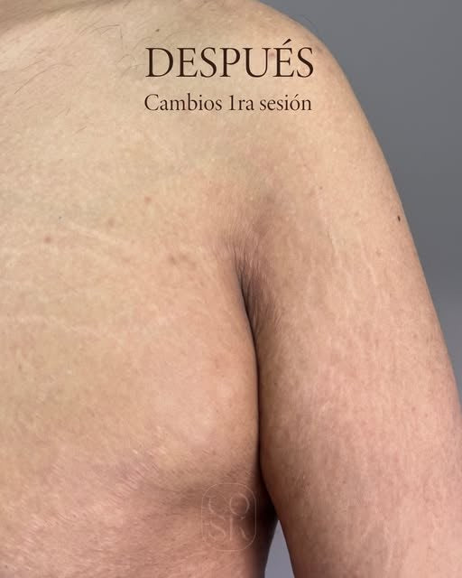 Después del tratamiento de estrías: Pecho