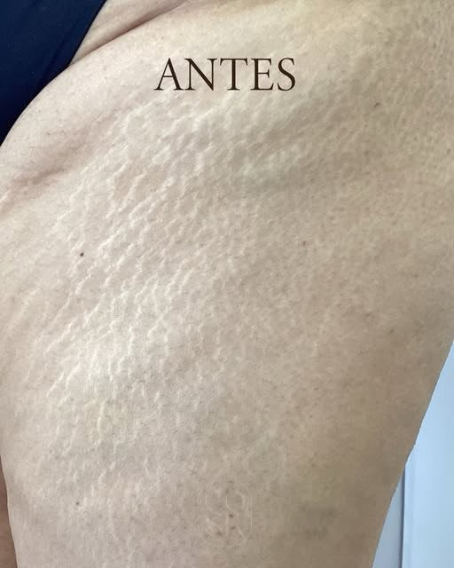 Antes del tratamiento de estrías: Pierna