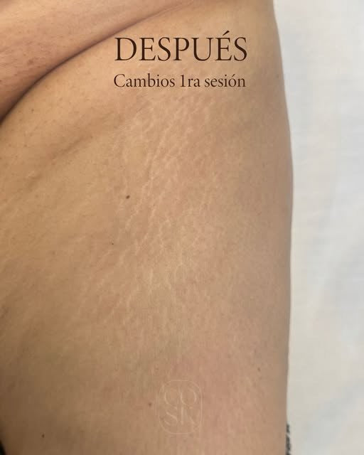Después del tratamiento de estrías: Pierna