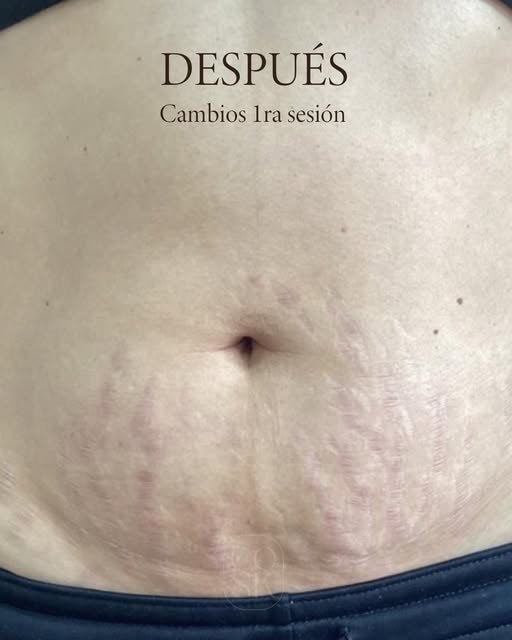 Después del tratamiento de estrías: Abdomen