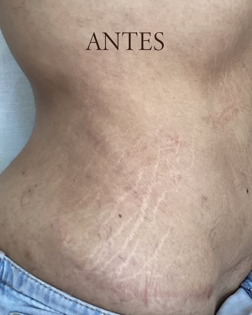 Antes del tratamiento de estrías: Cintura