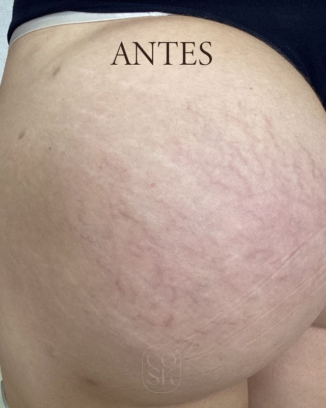 Antes del tratamiento de estrías: Glúteos